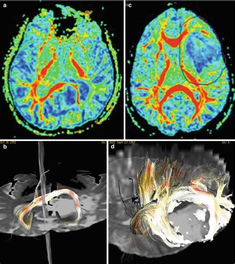 30t Imaging Of Brain Gliomas Radiology Key