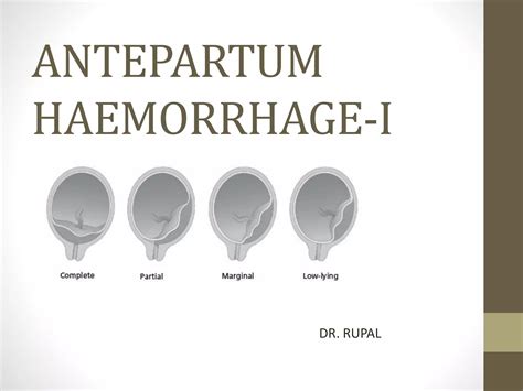 Antepartum Haemorrhage I Ppt