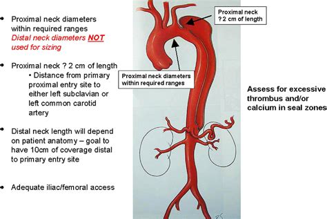 Aortic Dissection Stent