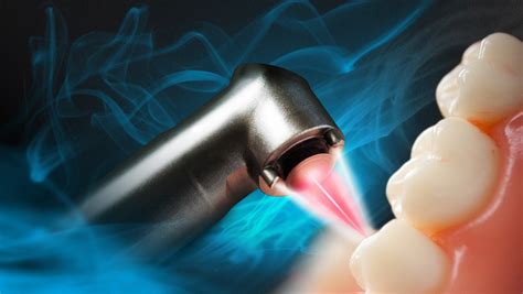 Laser Dentistry Consumer Guide | Dr. David Rodrick