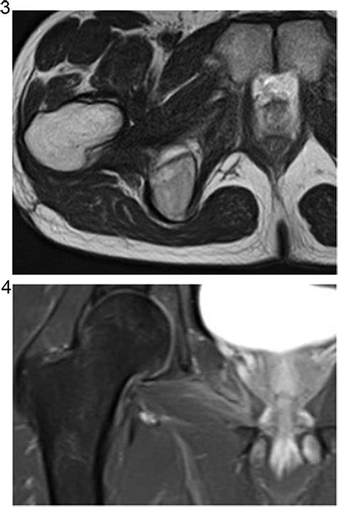 And 4 A Follow Up Mri Performed 5 Months After Onset Of The Disease