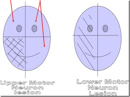 Upper motor neuron & Lower motor neuron lesions - Medatrio