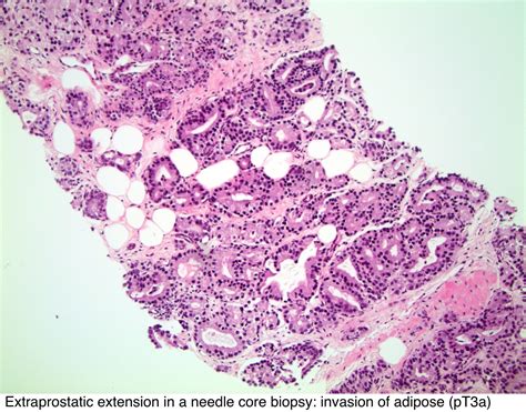 Pathology Outlines Staging