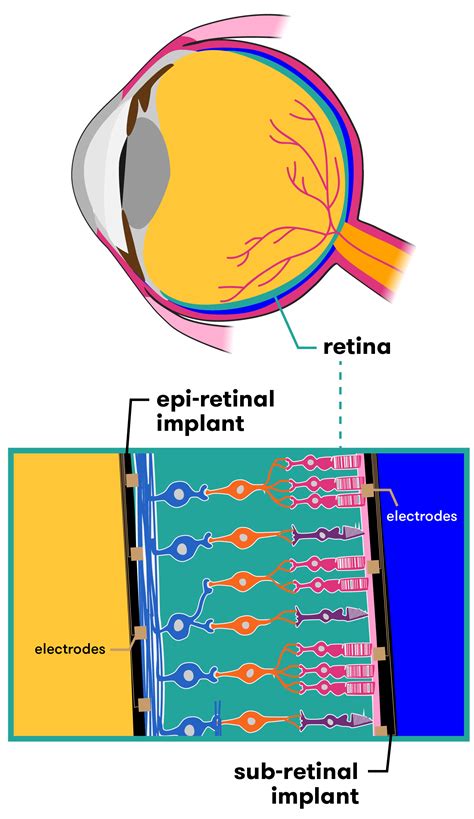 Seeing The Future The Bionic Eye Curious