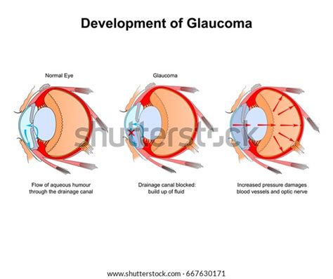 Development Glaucoma Diagram Eye Stock Vector Royalty Free 667630171