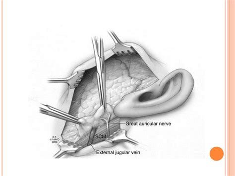 Parotidectomy Anatomy