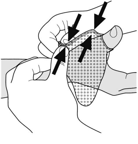 Guide Thumb stabilization splint - Orfit Industries Thumb Sprain ...