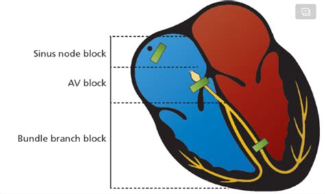 Cardiology Ekg Week Conduction Blocks Flashcards Quizlet