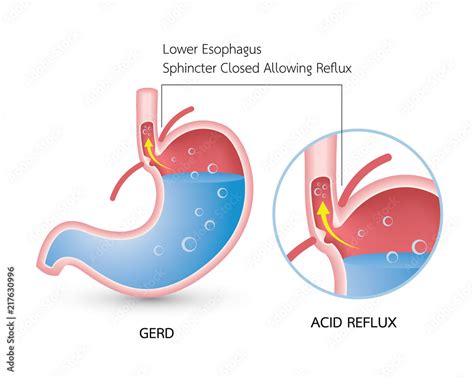 Vetor Do Stock Gastroesophageal Reflux Disease Gerd Acid Reflux