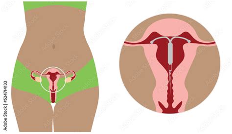 Intrauterine Device Iud Illustration Close Up To A Woman Uterus