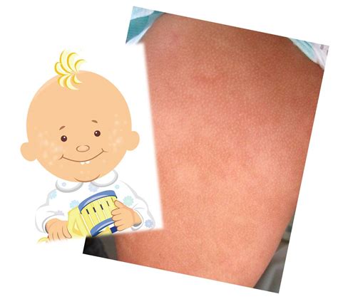 Manchas blancas en niños con dermatitis atópica Doctora Lorea