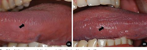 Figure 2 From Oral Hairy Leukoplakialike In An Immunocompetent Patient