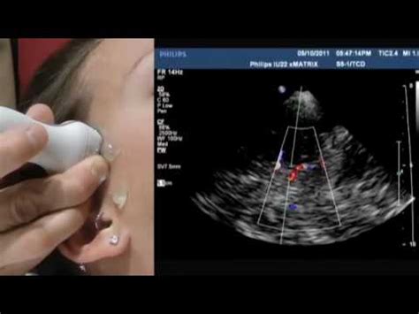 How To Transcranial Doppler YouTube