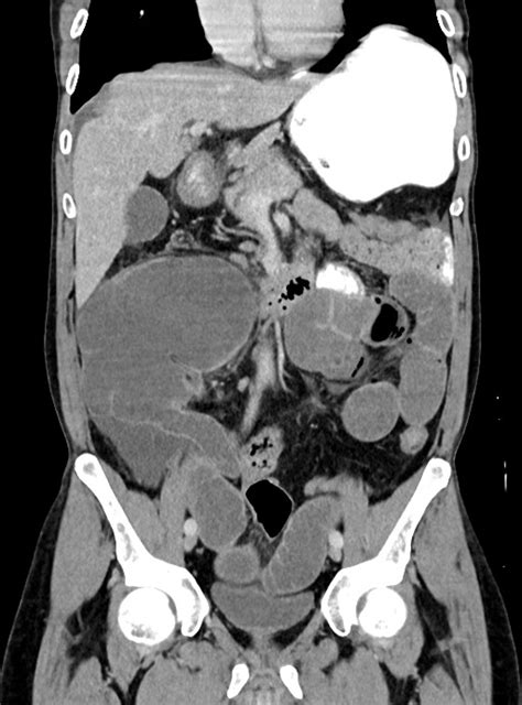 Colocolic Intussusception Due To Large Lipoma Image Radiopaedia Org