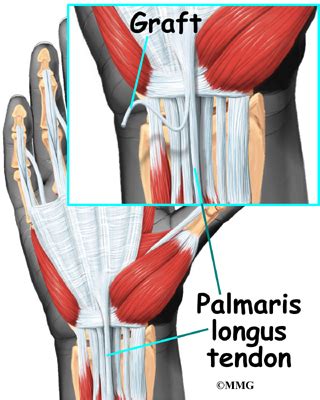 Wrist Ligament Injuries | eOrthopod.com