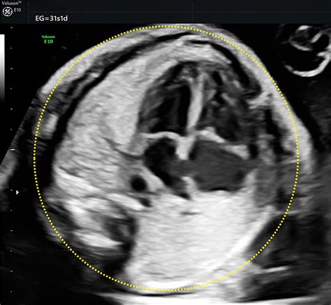 Ultrasound Evaluation Of The Fetal Thorax Article Glowm