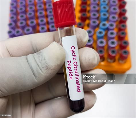 Blood Sample Tube For Cyclic Citrullinated Peptide Antibody Test ...