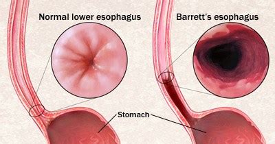 Barretts Esophagus Symptoms Treatments North Dallas Plano Tx Kedia