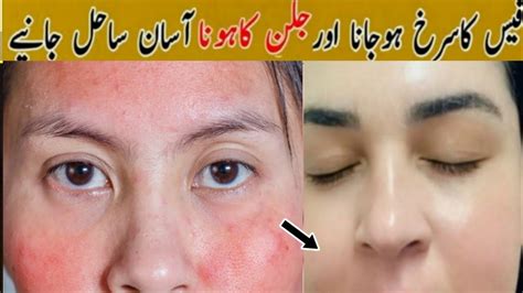 Face Ki Redness Khatam Karne Ka Tarika How To Remove Red Spots On Face