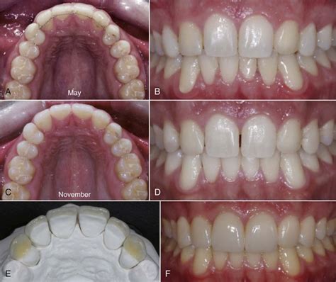 25 Missing Maxillary Lateral Incisors Pocket Dentistry