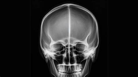 Linear Skull Fractures Mccarthy Co