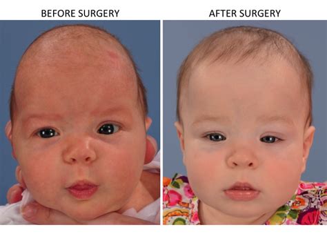 Minimally Invasive Endoscopic Sagittal Strip Craniectomy Before And