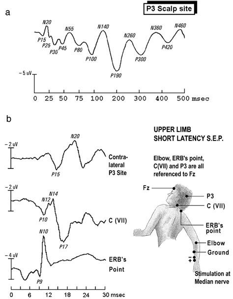 Diagram Of Somatosensory Evoked Potentials A Theoretical Example Of