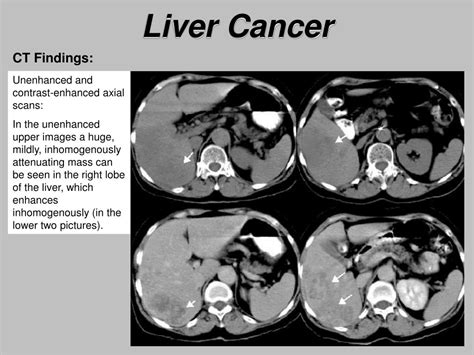 Ppt Liver Cancer Powerpoint Presentation Free Download Id6399378