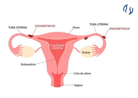 Endometriose Nas Tubas Uterinas Sintomas Dr Luiz Fl Vio