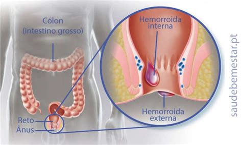 Como É Feito A Cirurgia De Hemorróidas - Cirurgia Hemorróidas - Operação de remoção das hemorroidas
