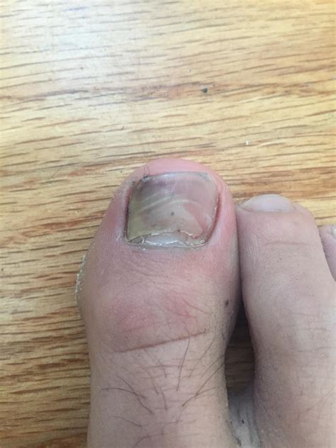 Split toe nail playing soccer today (someone stepped on it). Not