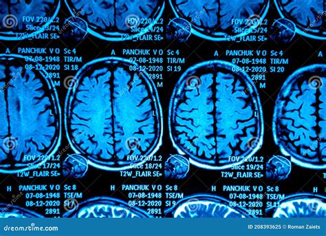 Mri Scan Of The Brain Magnetic Resonance Imaging Scan Stock Image