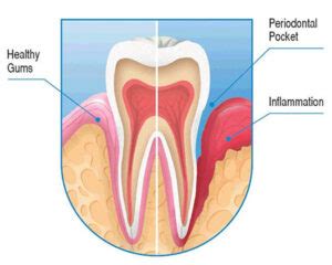 Periodontal Disease Treatment Brooklyn, NY | LuxDen Dentistry Center