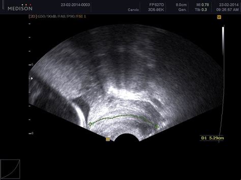 Transvaginal Ultrasound Assessment Of Cervical Length Download