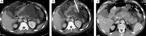 Contrastenhanced Computed Tomography CECT Abdomen A Before