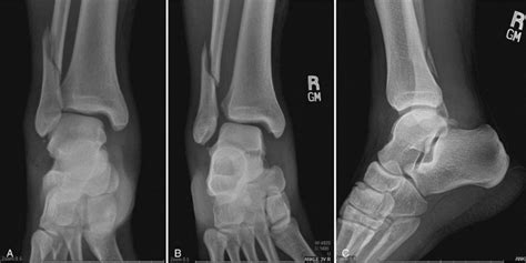 Ankle Syndesmosis Injuries - Assessment — Rayner & Smale