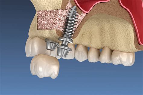 Regeneración Ósea Custom Dental Clínica dental en Barcelona