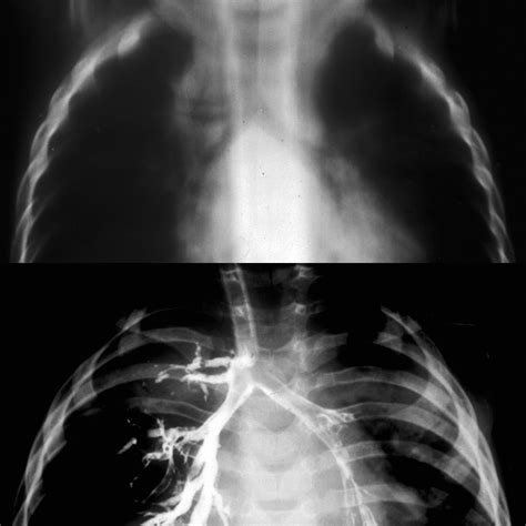 Pediatric Tracheal Bronchus Pediatric Radiology Reference Article