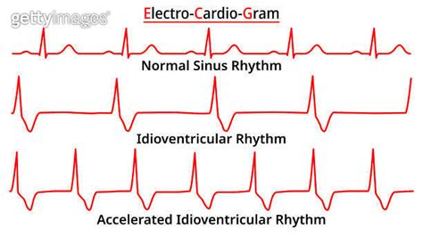 Set Of ECG Common Abnormalities Idioventricular Rhythm Vs Accelerated