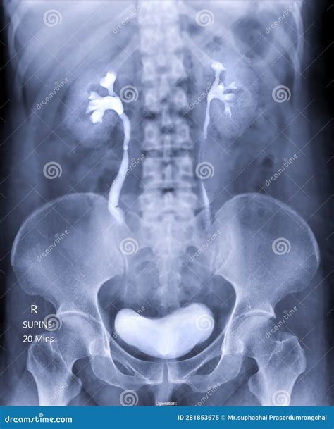 Intravenous Pyelogram Or I V P Stock Image Image Of Health