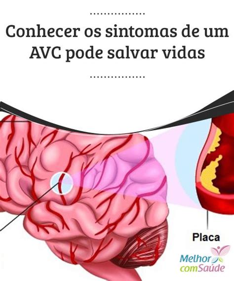 Conhecer Os Sintomas De Um Avc Pode Salvar Vidas Alergias Vida