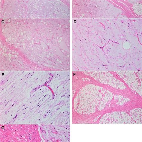 Well-differentiated liposarcoma/atypical lipomatous tumor. (A) WDL/ALT ...