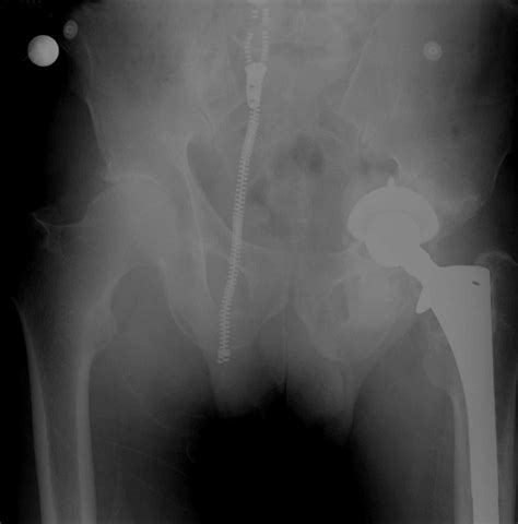 Two Centre Radiological Survivorship Of Acetabular Distraction Technique For Treatment Of