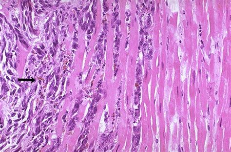 Heart tumor - Metastases / tumor extension