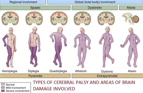 Cerebral Palsy - Cerebral Palsy &Seizure Disorders