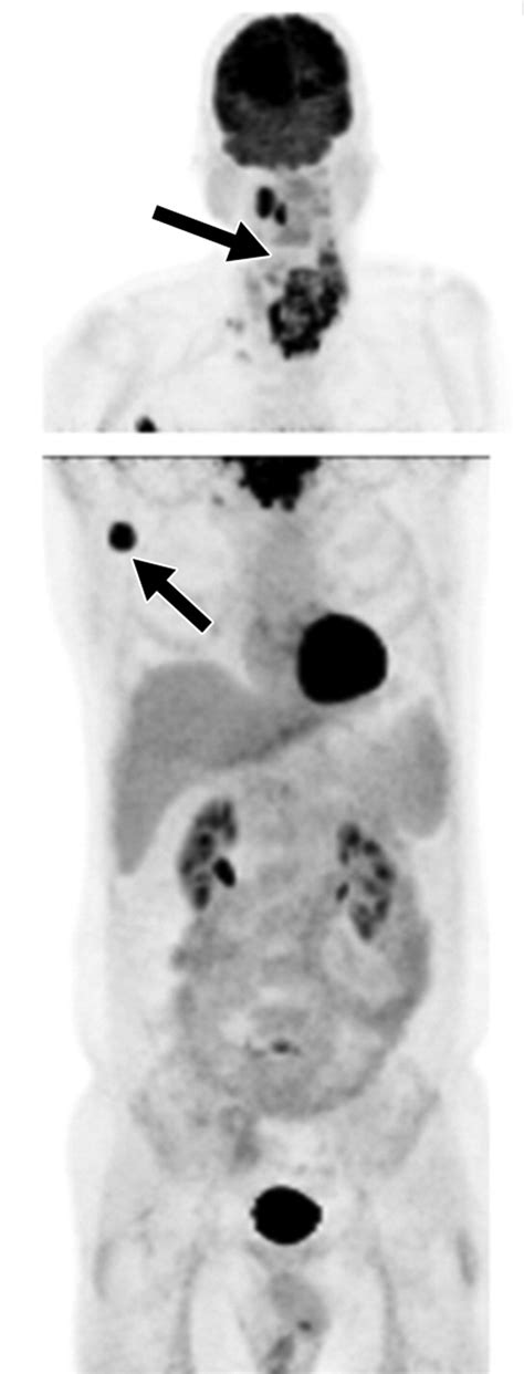 Petct In The Management Of Thyroid Cancers Ajr