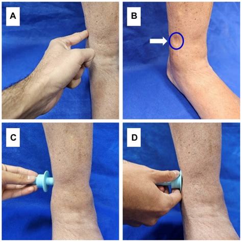 Quantitative Measurement Of Pitting Edema With A Novel Edema Ruler