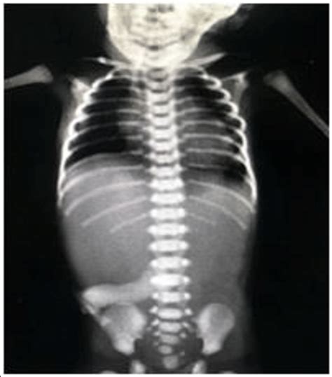 Esophageal Atresia X Ray