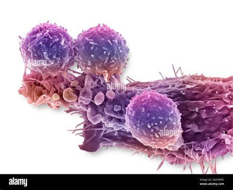 T Lymphocytes And Cancer Cell Coloured Scanning Electron Micrograph