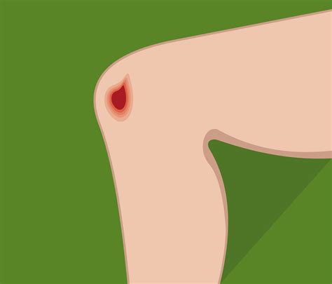 Petéquias E Equimoses - Petéquias, púrpuras, equimose, hematomas e apoplexia: você sabe a ...